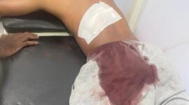 Korban perkelahian di Ternate Selatan saat di rawat di Rumah Sakit Chasan Boesoirie || dok : kasedata