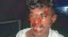 Korban Askir Sukardi (19) mengalami luka memar di wajah. || Doc : Ridal