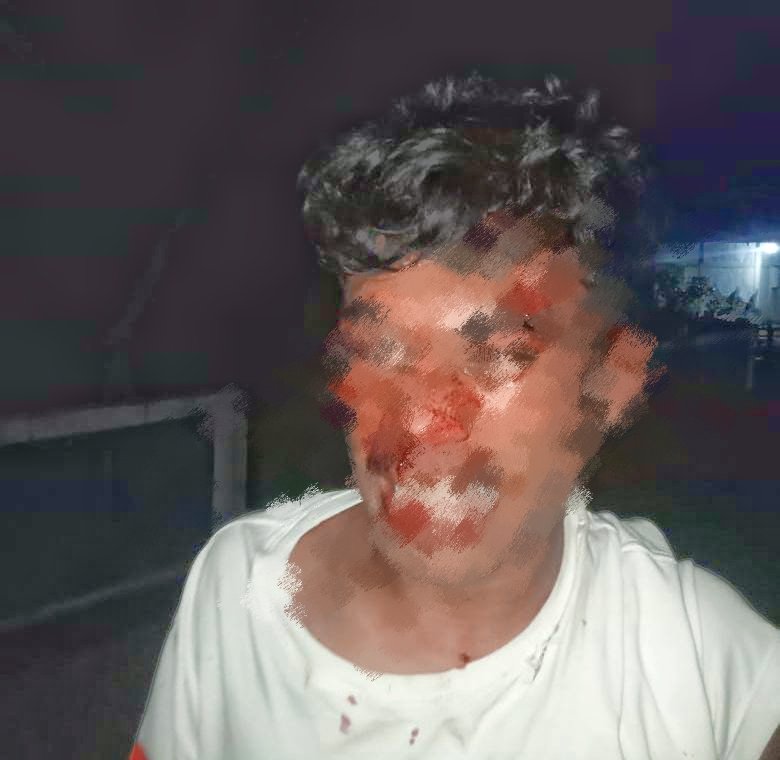 Korban Askir Sukardi (19) mengalami luka memar di wajah. || Doc : Ridal
