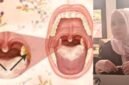 Ilustrasi penyakit difteri/Fungsional Epidemiologi Dinkes Ternate, Nuraini || dok : sukarsi_kasedata
