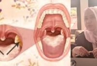 Ilustrasi penyakit difteri/Fungsional Epidemiologi Dinkes Ternate, Nuraini || dok : sukarsi_kasedata