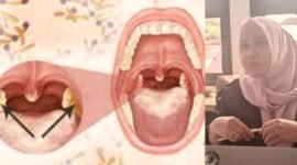 Ilustrasi penyakit difteri/Fungsional Epidemiologi Dinkes Ternate, Nuraini || dok : sukarsi_kasedata