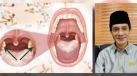 Ilustrasi penyakit difteri /Ketua komisi III DPRD Kota Ternate, Muhammad Syaiful || dok : sukarsi_kasedata